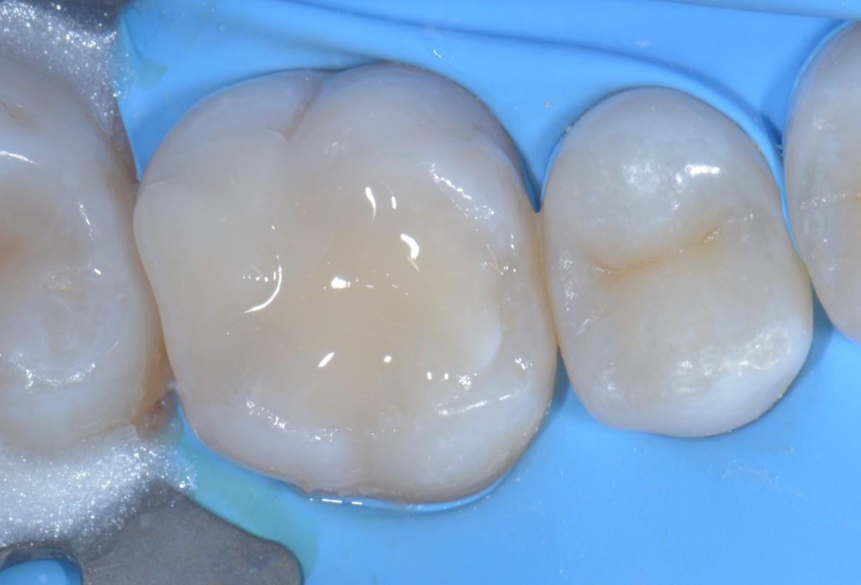 Teflon in odontoiatria - Stampaggio prime classi 3