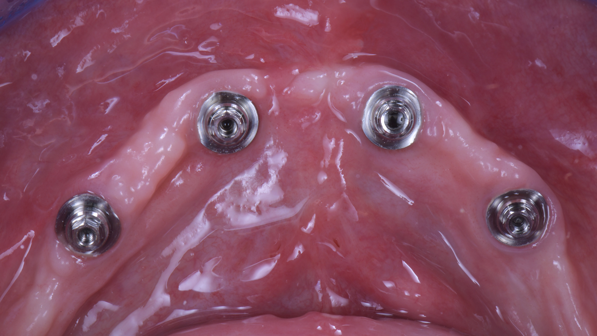Daglieli sti denti